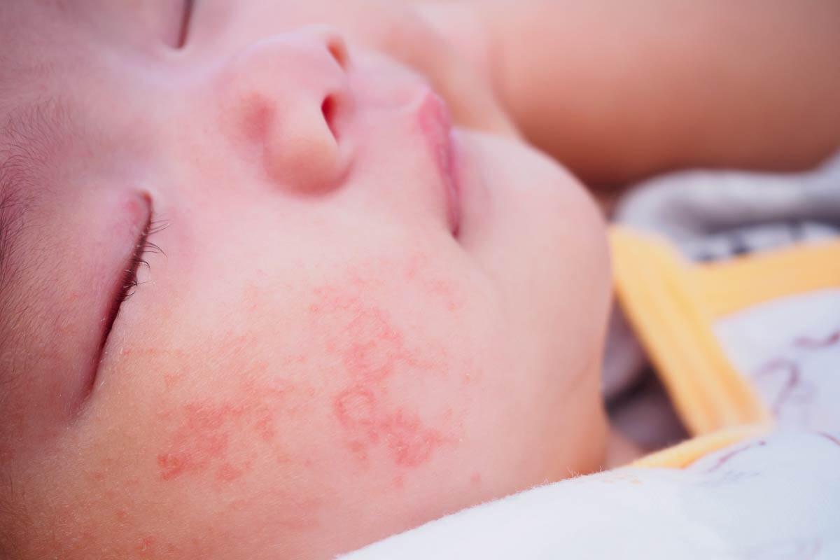 嬰兒乾燥型濕疹